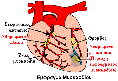 Βρήκαν τα γονίδια που φέρνουν εμφράγματα